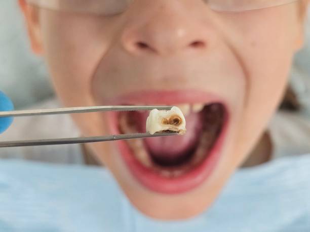 Best Emergency Gum Treatment in Walce Ridge, LA